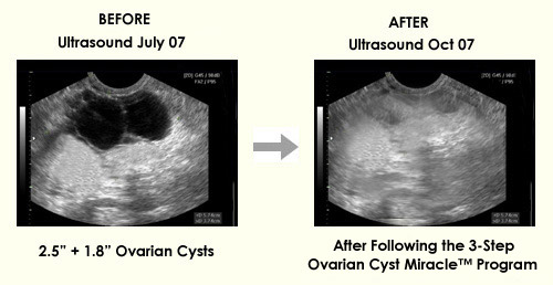 Ovarian Cyst Miracle™ - Cure Ovarian Cysts and PCOS Naturally