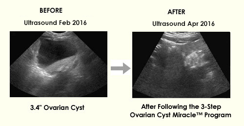 how-long-can-a-cyst-delay-your-period