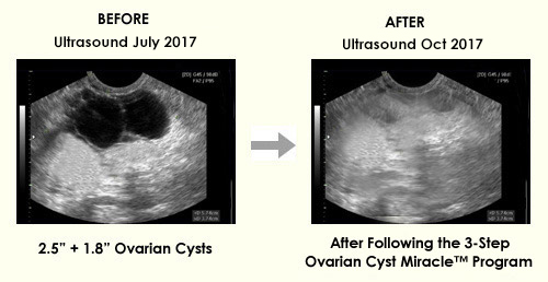 Ovarian Cyst Miracle™ Official Website Heal Ovarian Cysts And Pcos Naturally